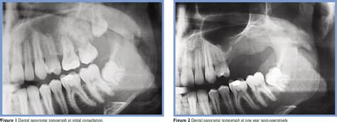 Figure 1 from Cementoblastoma in the Maxilla: A Case Report | Semantic ...