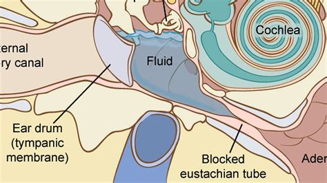 How To Cure Fluid In The Ear - Vastexamination2