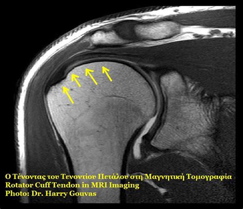 Rotator cuff surgery | General center | SteadyHealth.com