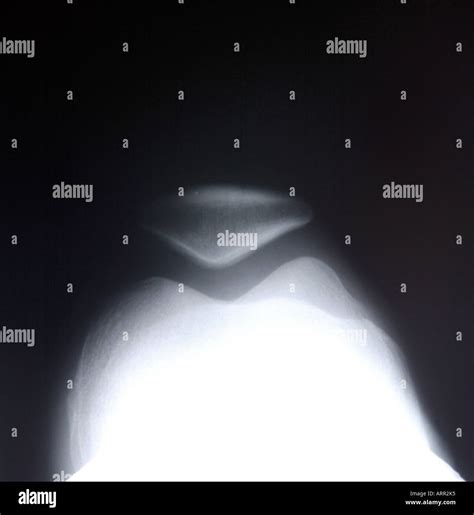 Normal knee xray hi-res stock photography and images - Alamy