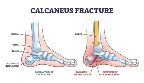 Calcaneus Fracture: Symptoms & Treatment by a Foot Specialist