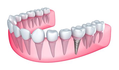 Here's Everything You Need To Know About Dental Implants - PJN Dental