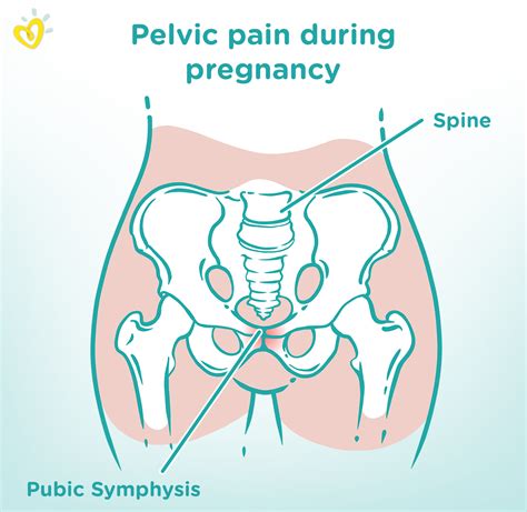 Symphysis Pubis Dysfunction: Causes, Symptoms Treatment, 57% OFF