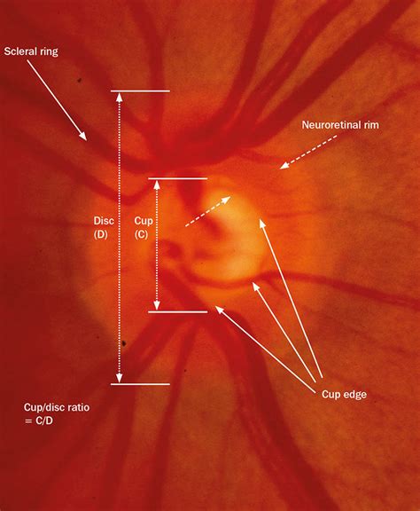 Photos Of Glaucoma Optic Nerve Cupping