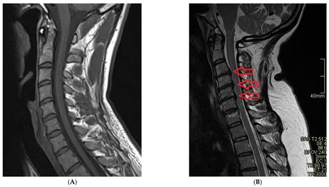 Differences Between A Normal Vs Abnormal Cervical Spine MRI, 55% OFF