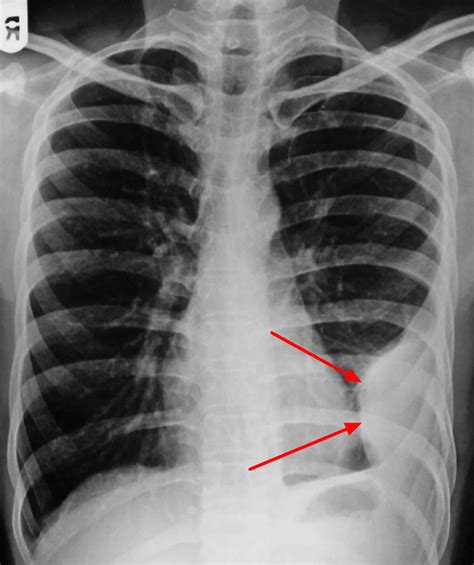 Pleural effusion causes, types, symptoms, diagnosis and treatment