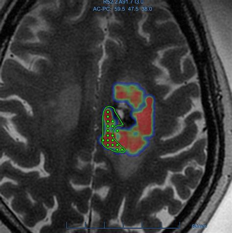 Focused Ultrasound–Enhanced Blood Test for Brain Tumors: World-First ...