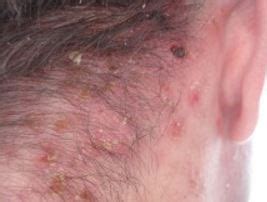 Shingles on Scalp, Symptoms, Pictures, No Rash, Swollen Lymph Nodes ...