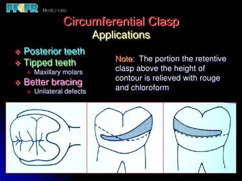 5.retainers, clasp assemblies and indirect retainers