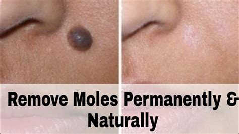 Skin Moles Removal Naturally