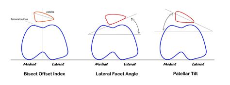 Does Patellar Tracking Disorder Cause Knee Pain? - Massage & Fitness ...