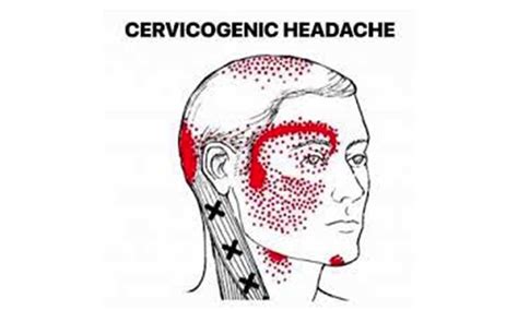 Cervicogenic Headaches: Arash Noor, DC, CCSP, CSCS, EMT-R: Chiropractor