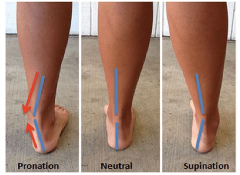 How Pronation, Overpronation, and Supination Affect You