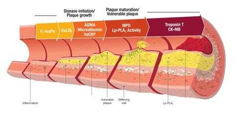 Atherosclerosis Diagram