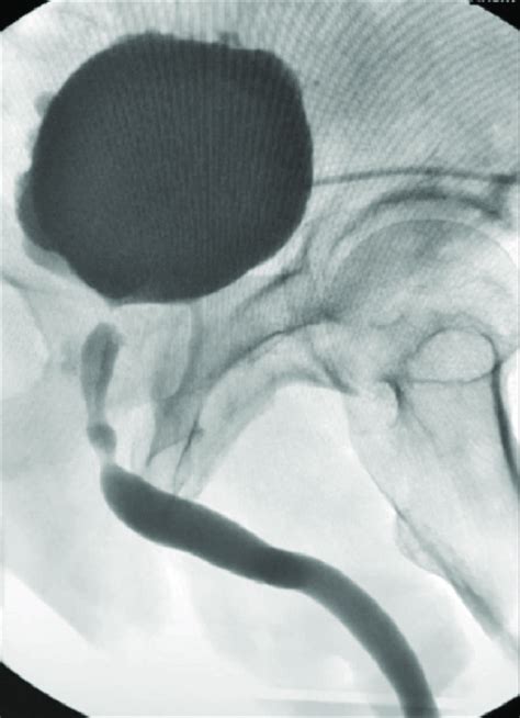 Preoperative ascending urethrogram showing bladder neck contracture ...