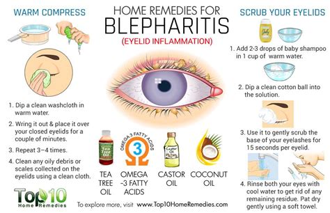 Home Remedies for Blepharitis (Eyelid Inflammation) | Top 10 Home Remedies