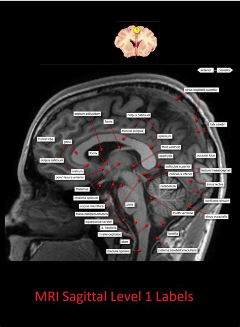 MRI Sagittal Anatomy of Brain Level 1 - NCLEX Quiz