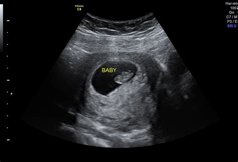 Pregnant Ultrasound – Telegraph