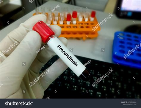 Blood Sample Procalcitonin Pct Test Diagnosis Stock Photo 1876865086 ...