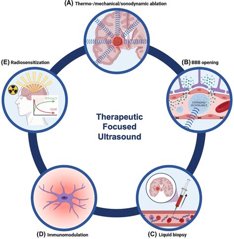 Modes of action of therapeutic focused ultrasound to treat brain tumors ...