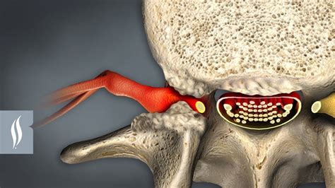 What is foraminal narrowing? | Laser Spine Institute | Stenosis, Spines ...