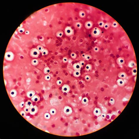 Tinción de gram: meningitis con Cryptococcus neoformans. Encontrado en ...