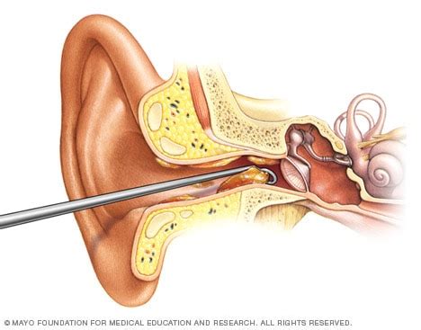 Ear Wax Removal Kit Catalina - Oro Valley Audiology