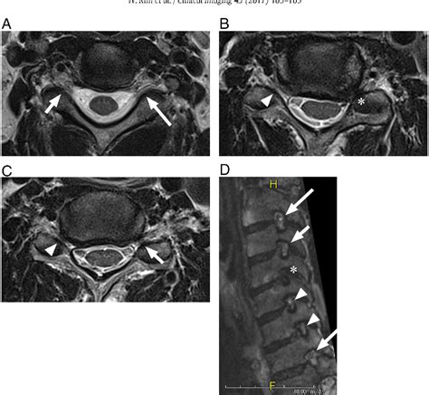 Table 1 from Comparison of MRI grading for cervical neural foraminal ...