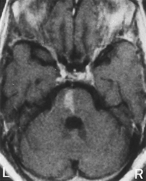 Lateral Pontine Syndrome Mri