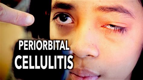 PERIORBITAL CELLULITIS (Painful!) | Dr. Paul - YouTube