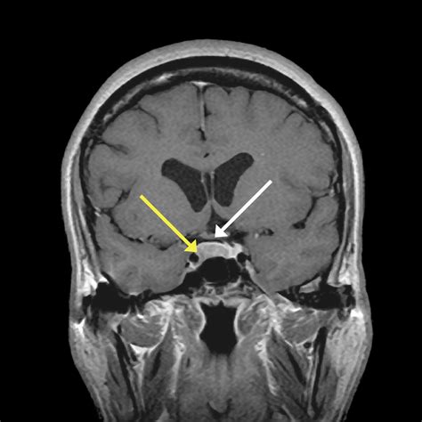 MRI Studies of the Patient's Pituitary Gland MRI of the pituitary gland ...