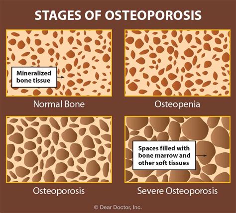 Osteoporosis Drugs and Dental Treatment