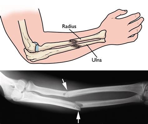 Ulna Bone Fracture