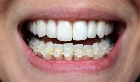 Six Month Smiles adult braces | xameliax | Health & beauty