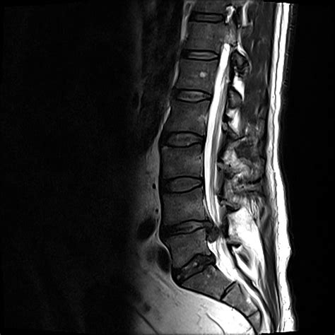 Lumbar Spine Mri Bulging Disc