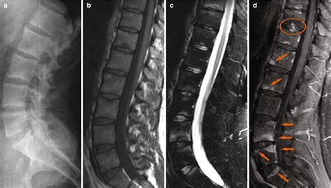 Ankylosing Spondylitis Thoracic Spine