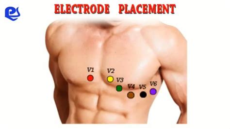 Ecg Leads Placement Diagram