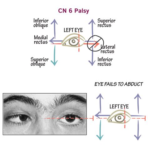 Cranial Nerve Palsy Causes