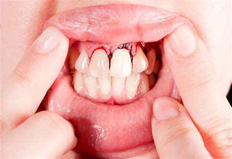 What happens to an untreated tooth abscess | drgibberman.com