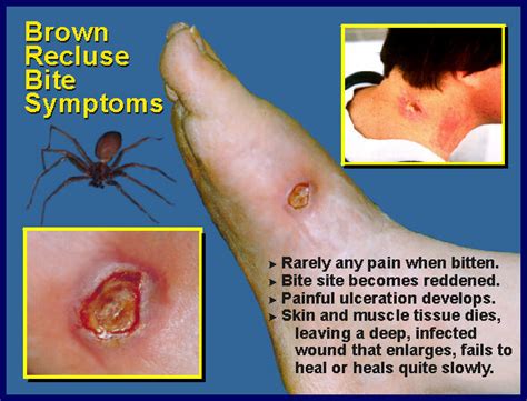 Brown Recluse Spider Bite Symptoms | Department of Entomology