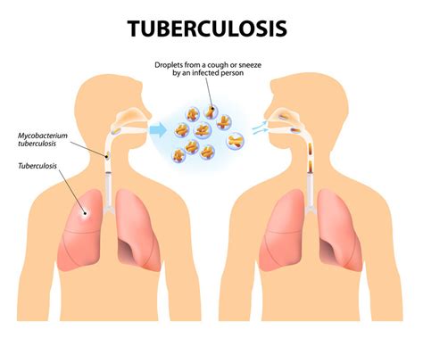 Tuberculosis - Harvard Health