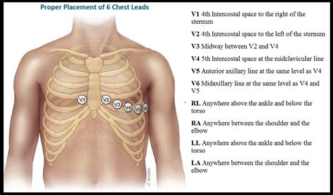 Printable Ecg Placement Diagram