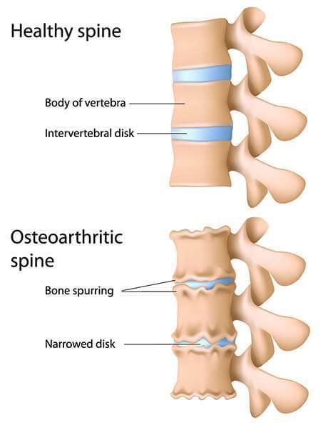 Lower Back Arthritis | Spinal and Sports Care Parramatta, Castle Hill ...