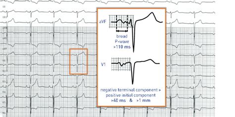 Left atrial enlargement | Cardiocases