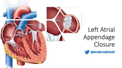 emDOCs.net – Emergency Medicine EducationLeft atrial appendage closure ...