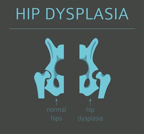 Hip Dysplasia | Add More to Life - Meril