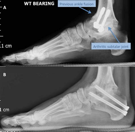 Subtalar Arthritis | Arthritis Of The Subtalar Joint | LFAC (2022)