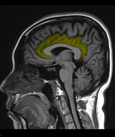 Cingulate gyrus | Radiology Reference Article | Radiopaedia.org