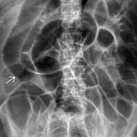 Ileus | Radiology Key