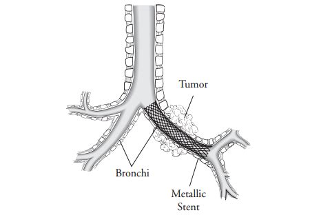 Tracheal or Bronchial Stent Placement | Memorial Sloan Kettering Cancer ...